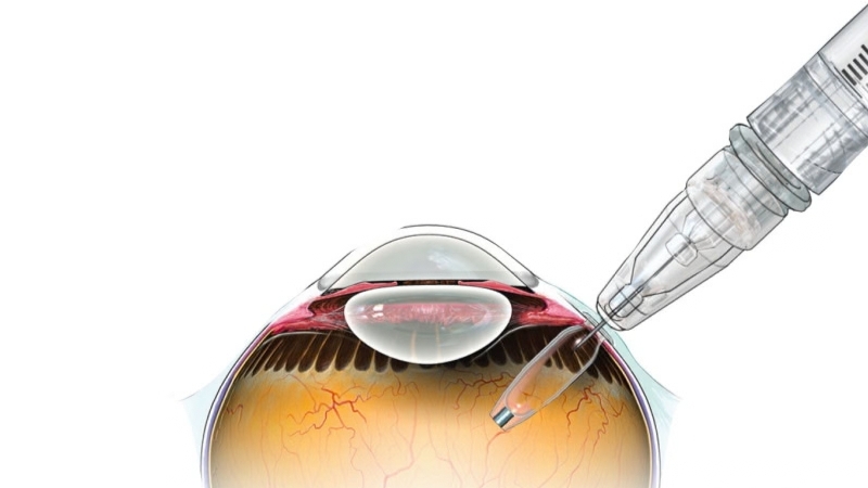 En medicinsk illustration visar ett öga i genomskärning. Uppe till höger syns en spruta vars nål förs in i ett litet avlångt implantat som sitter i ögats ytterkant, för att fylla implantatet med läkemedel.